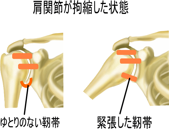 肩痛靭帯図.gif